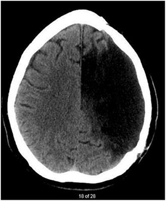 Does Right-Hemispheric Anodal tDCS Enhance the Impact of Script Training in Chronic Aphasia? A Single-Subject Experimental Study